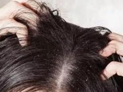 頭皮敏感多頭屑?這款護理精油不可用